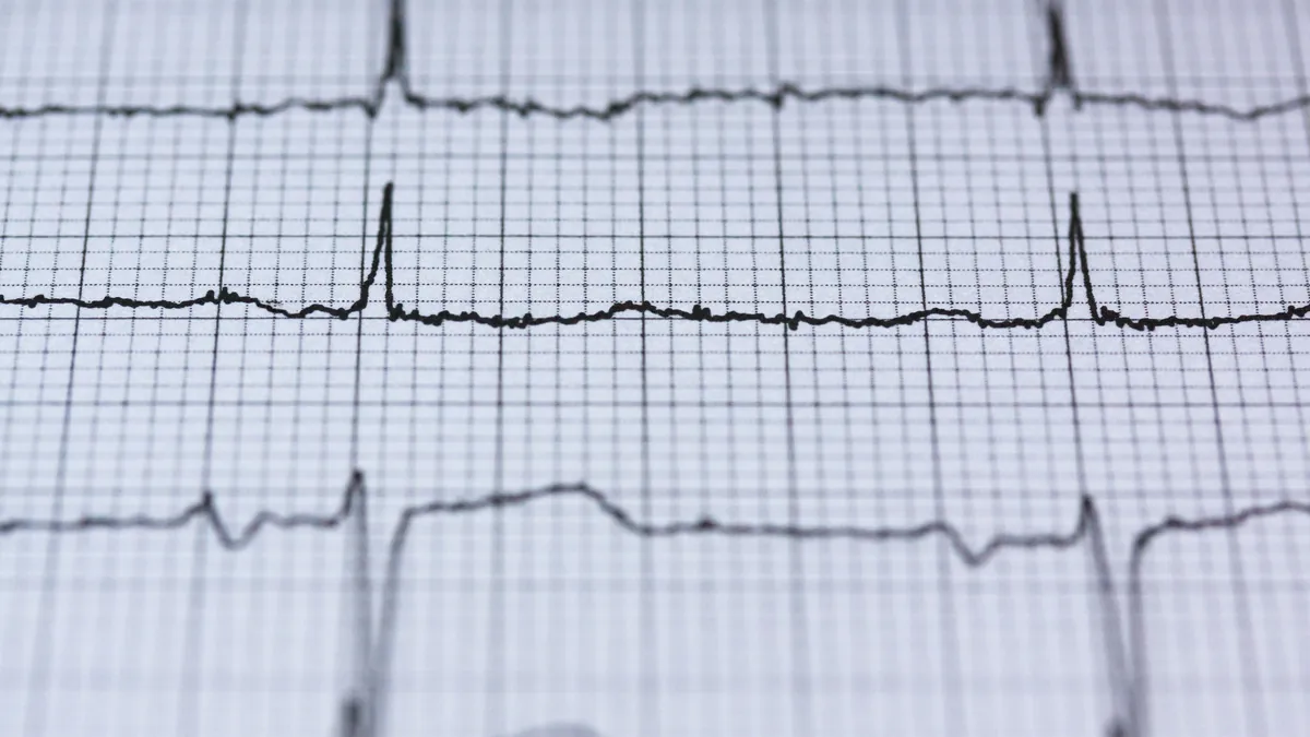 An ECG tracing on grid paper showing the spacing between heartbeats